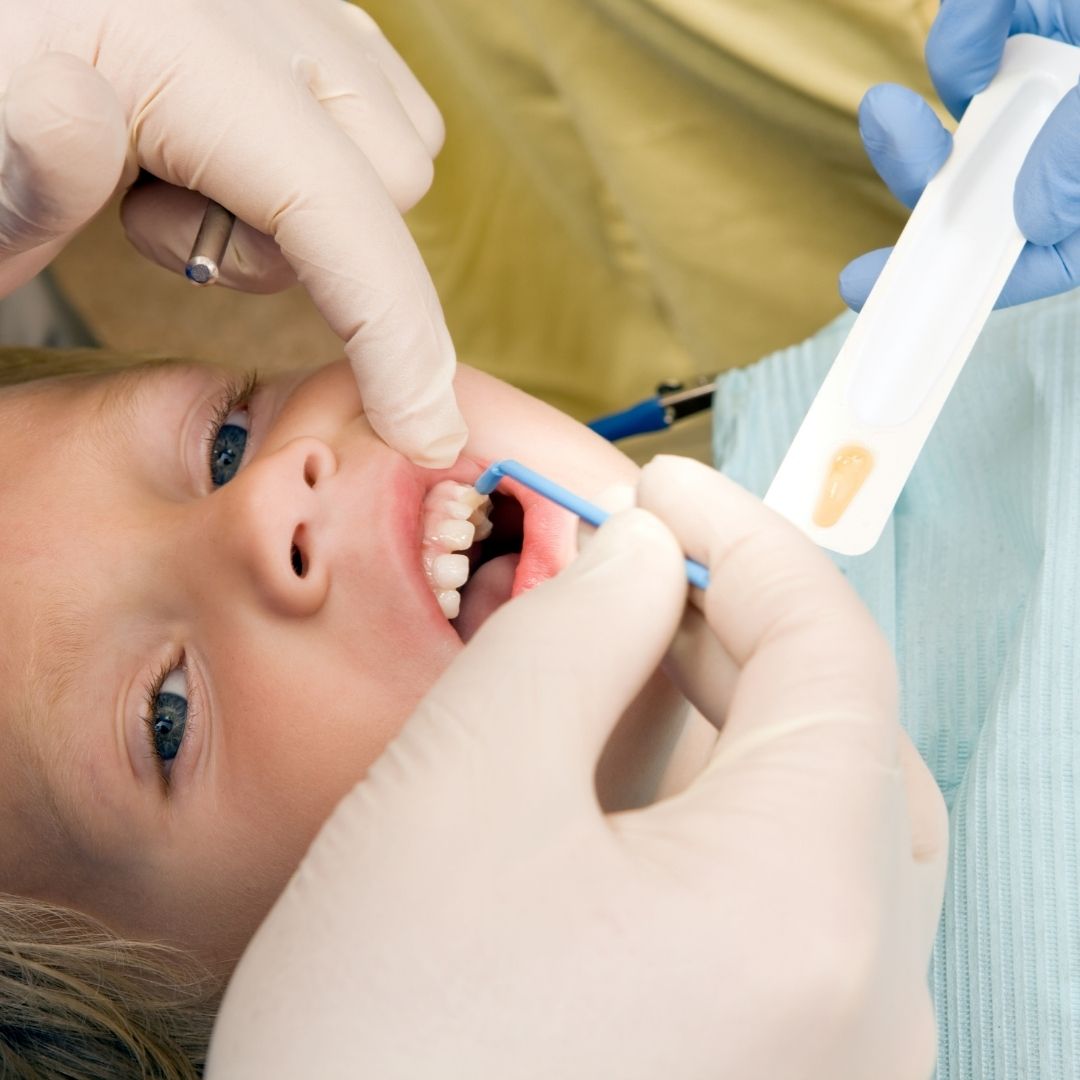 fluoride treatment on child's teeth